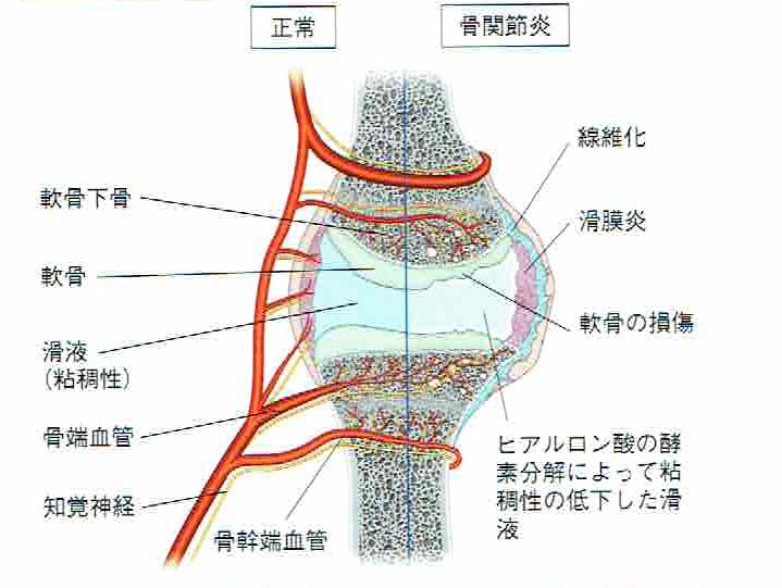 関節炎（変形性関節症）